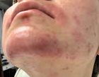 After ScarletElectrolysis.com Chin Hair Removal