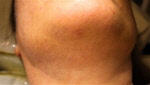 Before ScarletElectrolysis.com Chin Hair Removal
